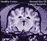 Healthy brain
